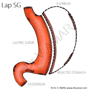 sleeve-gastrektomi